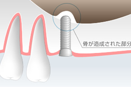 ソケットリフトのイメージ