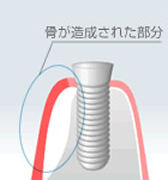 GBR（骨再生） のイメージ