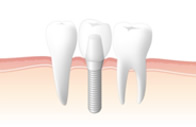 インプラントのイメージ